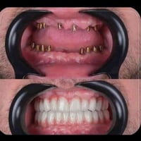 زراعة الاسنان • زرعات سويسرية • قضاء البدير