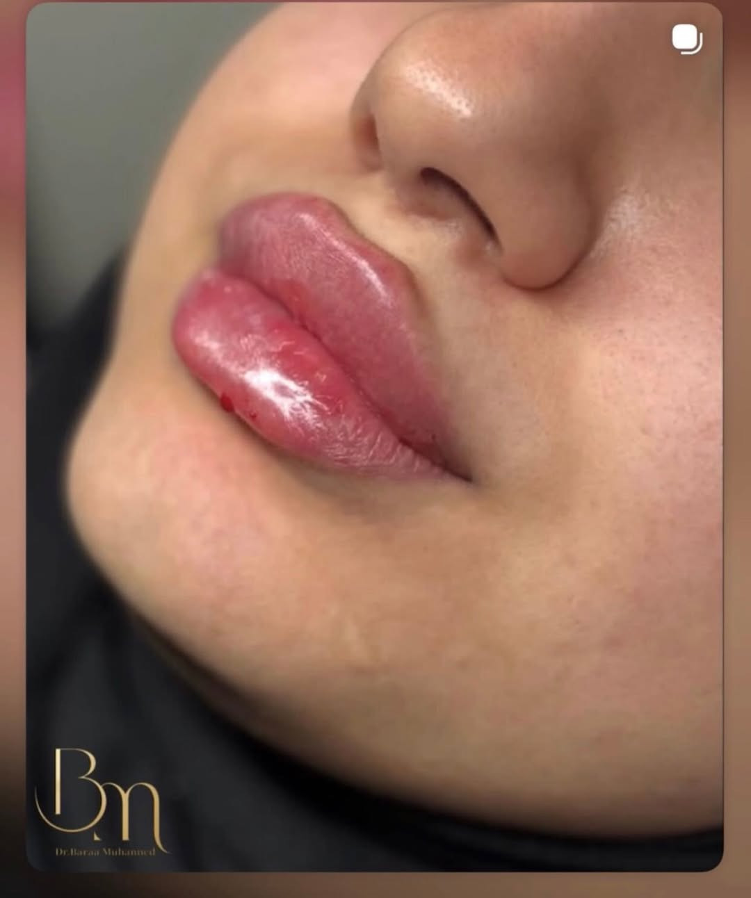 مع كثرة عيادات التجميل تتميز الدكتورة براء السوداني بنظافة وجمال الشغل عنوان العيادة شارع الاطباء قرب السوق الصغير مجاور مركز السفير داخل عيادة فيروز 
للحجز السريع او الاستفسار واتساب ***********
