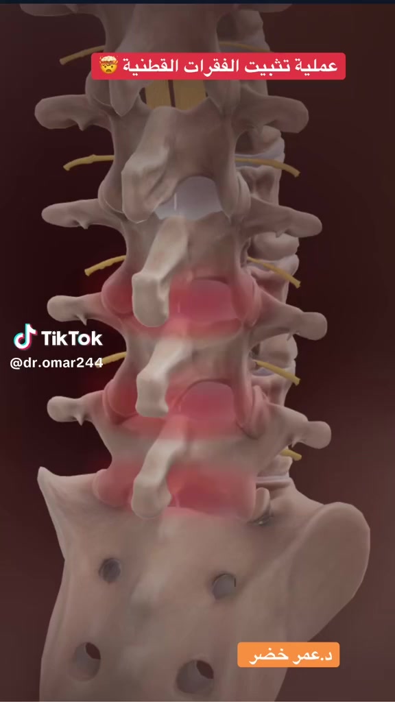 يتواجد يوم الأأحد مساءً والثلاثاء مساءً 
🩺 الدكتور سرمد عبدالله زنگنة

​طبيب اختصاص جراحة الجملة العصبية
حاصل على شهادة البورد (الدكتوراه) في جراحة الدماغ والحبل الشوكي
​الخدمات والعمليات الجراحية:
​علاجات العمود الفقري: آلام الظهر والرقبة، عرق النسا، الانزلاق الغضروفي، وعمليات فتح وتثبيت الفقرات.
​جراحة الدماغ: عمليات فتح الجمجمة لإزالة الأورام والنزيف، تجميل الجمجمة، وعلاج الصداع والشقيقة.
​الجراحات التخصصية: فتح النفق الرسخي، زرع كافة أنواع الصمامات، وعلاج التشوهات الولادية للجهاز العصبي.
​📍 معلومات الموقع والحجز:
​العنوان: كركوك — الحويجة — شارع الأطباء — مجمع الرشيد الطبي (مقابل صيدلية الشهد وعمارة الخياطين).
​أرقام الحجز والاستفسار:
​***********
​***********
