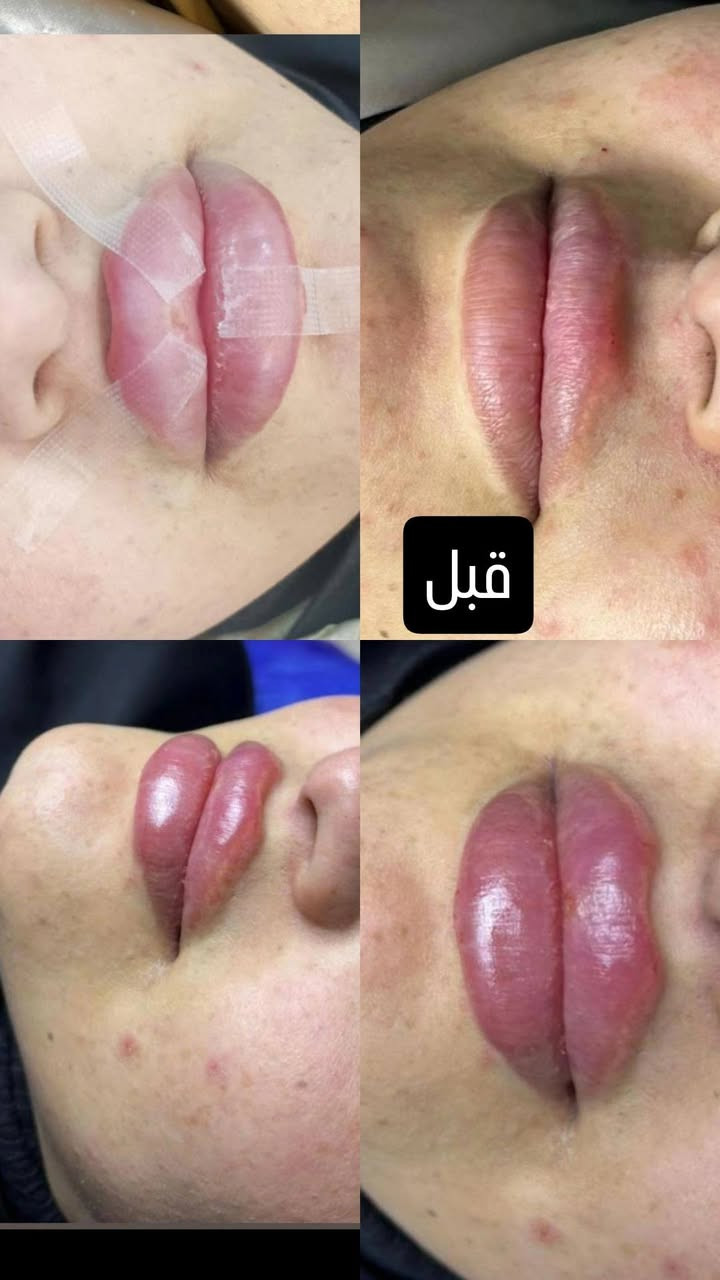 عروضنه الحلوه
فلر ديلوكس ب 50 الف
فلر براند لكوري ب 75
4 سيسي فلر 240
6 سيسي فلر 360
8 سيسي فلر480
10 سيسي فلر600


**إذا كنت صاحب هذا الإعلان وتريد حذفه لأي سبب، رجاءا أرسل رسالة إلى الدعم الفني**