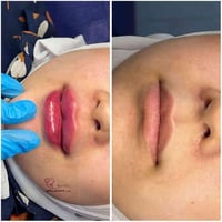 فيلر شفة • عيادة تجميل • مجمع علم الكندي