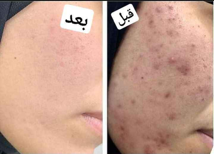 الف رحمه على روح امه وابوه اليعلقلي هذا مصدر رزقي الوحيد #يارزاق 🤲❤️
خلطة بشرة تجنن تسوي الوجه گيمر 
طبعا تستخدم للرجال ونساء 

#خلطه عباره عن سيرومات مابيه اي مضره  شغلها يخبل  وفوائده تجنن على بشره 
تعالج مشاكل البشره تصبغات اسمرار كلف حبوب نمش يعني هي تساعد البشره تعيد حيويته تنطيه نضاره حلوه

للحجز مراسله الخاص
او واتساب *********** دهل اوران, واسط
