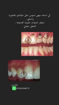 مجانا حشوات الأسنان الأمامية بجلسة واحدة  واتساب  07850268737