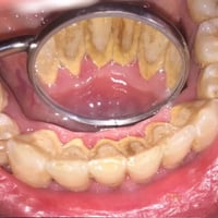 الحلة • تنظيف اسنان • تبييض اسنان