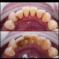 اي شخص عندة تكلسات وتصبغات او اسنانة تالفة ومحتاج قلع  يراسلني على الر...