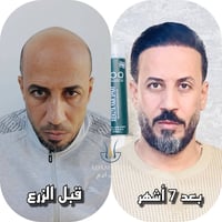 من الصلع للثقة 💯  👀 شوف النتيجة بنفسك: ✔️ خط جبهة طبيعي  ✔️ كثافة حقيق...