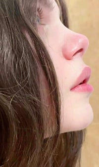 سيروم تصغير الأنف • غير جراحي • تذويب دهون