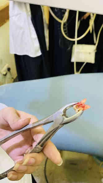 الي عنده حشوة او قلع او تنظيف اسنان مثل ماموضح بالصور وحاب يعالجهن يتواصل ويانه بالخاص العلاج مجاني تحت إشراف أطباء اختصاص 
العنوان : الحلة ،شارع أربعين،مجاور صيدلية سلامتك

‭٠ ٧٨٦ ٤٦٨ ١٦١٦‬الحجز واتساب
