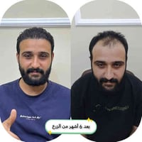 زراعة الشعر باحدث تقنية (تقنية الزفير العالمية)✔️  بكثافة عالية 🧔  ‏وع...