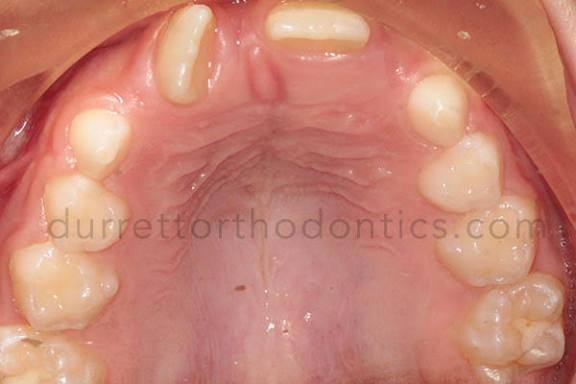 السلام عليكم 
الي محتاج علاج تقويم مثل هل حالات  بلصور لعمر 15 واقل مجانا يراسل علرقم ***********
من شهر الثاني نبلش فراح اثبت فقط لطفل واحد الي يريد يراسل
