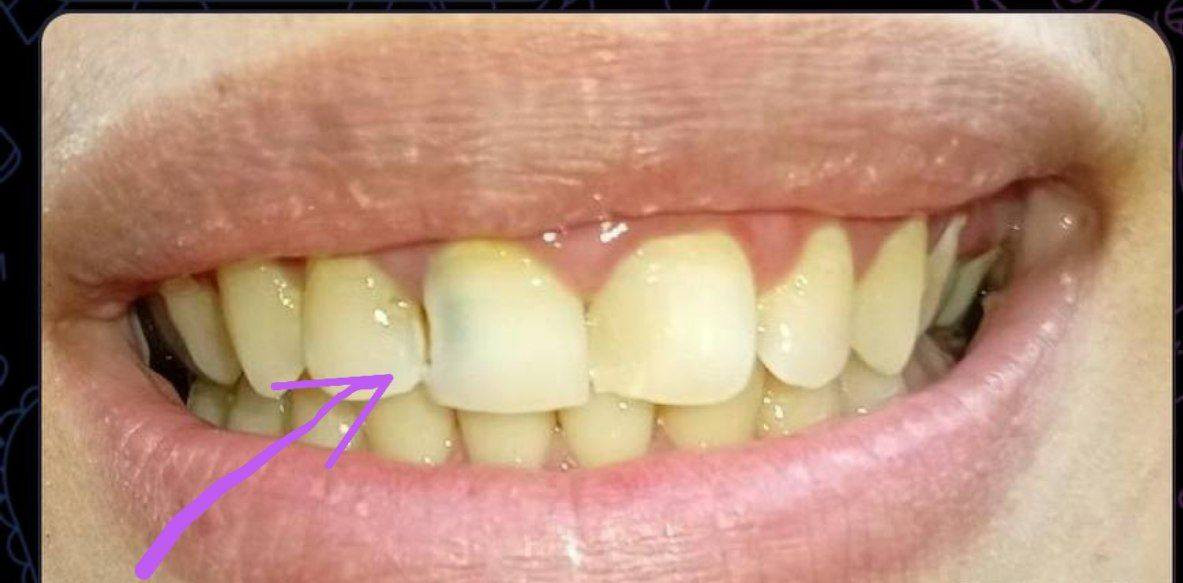 السلام عليكم
معالجة هذه الحالات المتسوسة وحشوات الجذور للأسنان الأمامية 
مجاني 
#حلة شارع 40 
للحجز واتساب/***********
