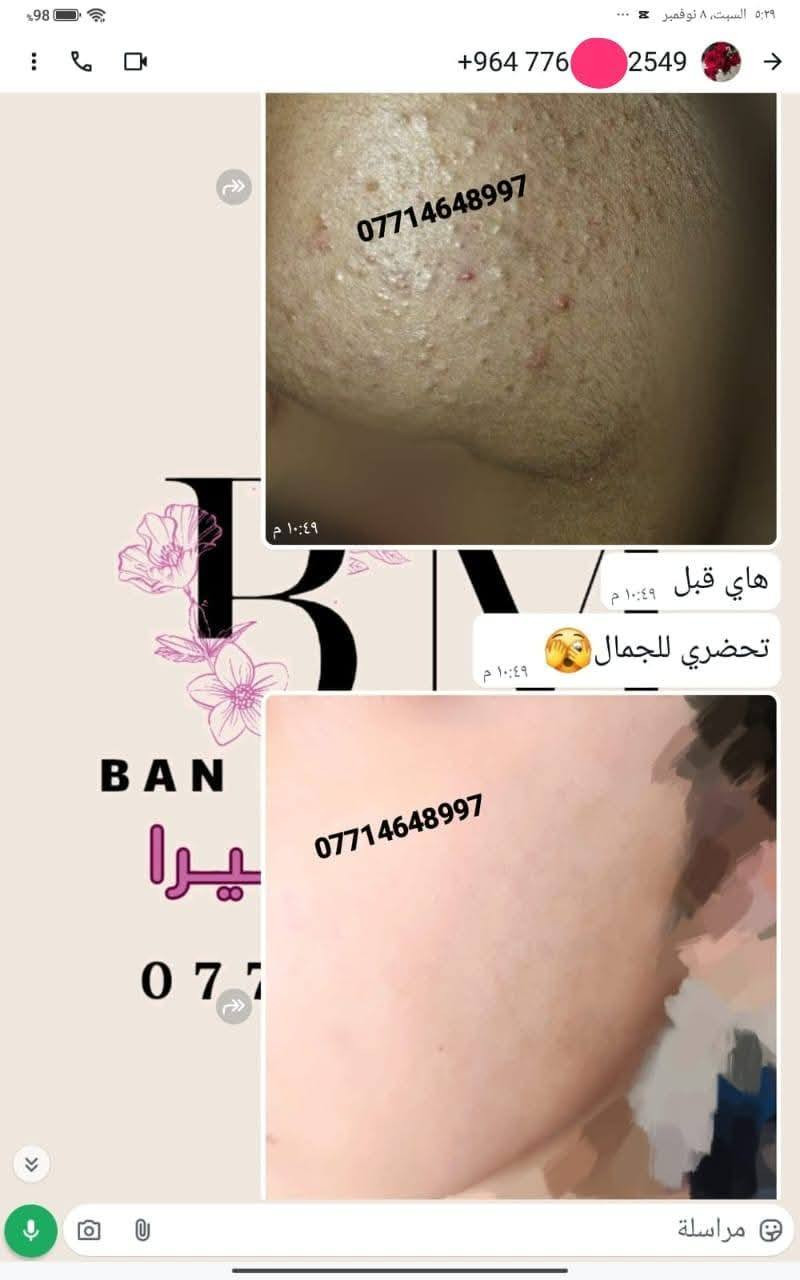 🙏انتبااااااااااه 🙏  الحجز فقط (وتساااااب ) علا اوليفيرا  ***********77
الي يعانوون من جميع مشاكل البشره مع منتجاتنا الطبيعيه  تمتعي ببياض الثلج 😍
 معالج الفااوربتين و السيراميد والعنبر وسيروم الباكشويل وسيىوم النضاره بكج متكامل 
تفتح البشرة 7 درجات والنتيجة دائمية 👌 وهذي تجارب زبائني تشهد 
خدمه توصيل لجميع محافضات
