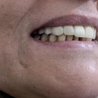تراكيب لمراجعة تعاني من فقدان اسنان اماميه 😁✅  مع عيادة الدكتور حيدر ا...