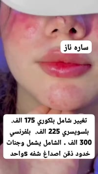 فلر شفاه • تغيير شامل • بغداد الجديده