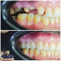 تركيب زركون • مطابقة لون • المسيب شارع البلدية