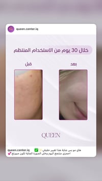 Queen cream • تفتيح البشرة • ضمان ٢١ يوم