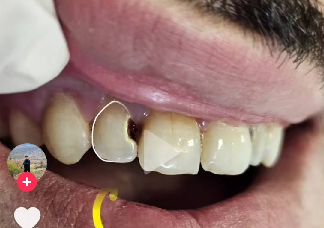 السلام عليكم ورحمه الله وبركاته
الي عندة تسوسات بأسنانه تشبه هاي الصور او كسر بلأسنان الامامية يراسلني على هذا الرقم واتساب ***********علما بأن العلاج مجاني وبأشراف دكاترة مختصين وبعيادات نظيفة تضمن راحة المريض
