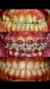 تقويم اسنان • زراعة اسنان • الخالدية شارع عشرين