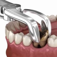 علاج أسنان مجاني • عيادات الكنوز • فلورايد أطفال