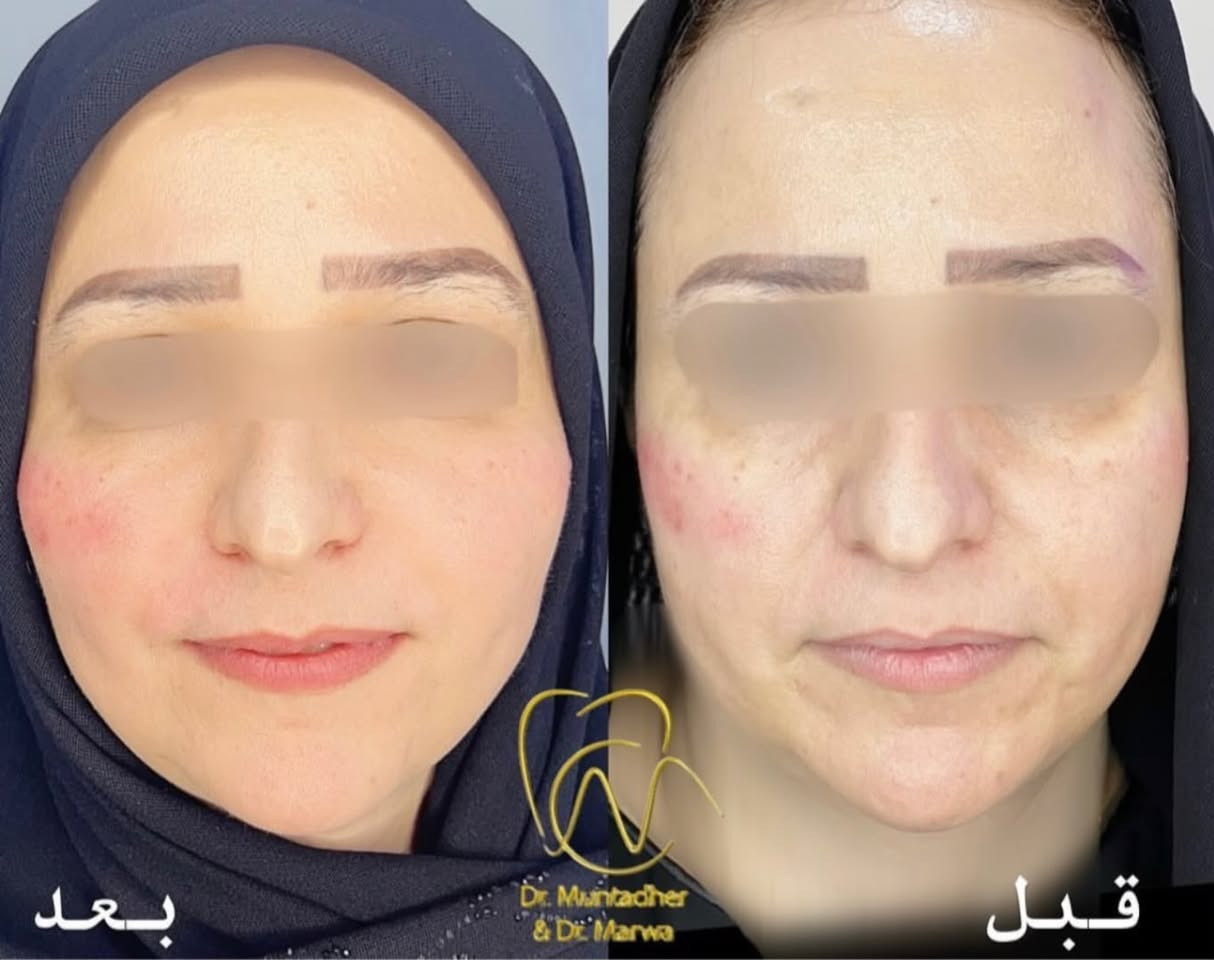 تغيير شامل بصورة طبيعية بطريقة السحب والشد وعكس عقارب الساعة😍صايرين احلى بدون ميعرف المقابل شنو مسوين 💙
برأيكم كم سنة صغرت بالعمر ؟ 

عيادة الدكتورة مروة محمد التميمي

🏥الديوانية العروبة-شارع المتحف-مجاور مطعم كودو كودو
📞رقم الحجز ***********

متوفر نظام التقسيط على الماستر كارد
