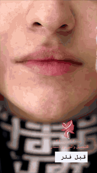 #عيادة فلورا للتجميل والليزر والاسنان 

#جلسه فلر شفه حسب طلب المراجعة ❤️

 #العنوان؛ طوز _ سوك الجمهوريه  _ مجاور ملبوسات مختار 
طابق تأني لجامعة 
الرقم؛ ***********📞

#علما_ليس_لدينا_فرع_اخر 🧿
