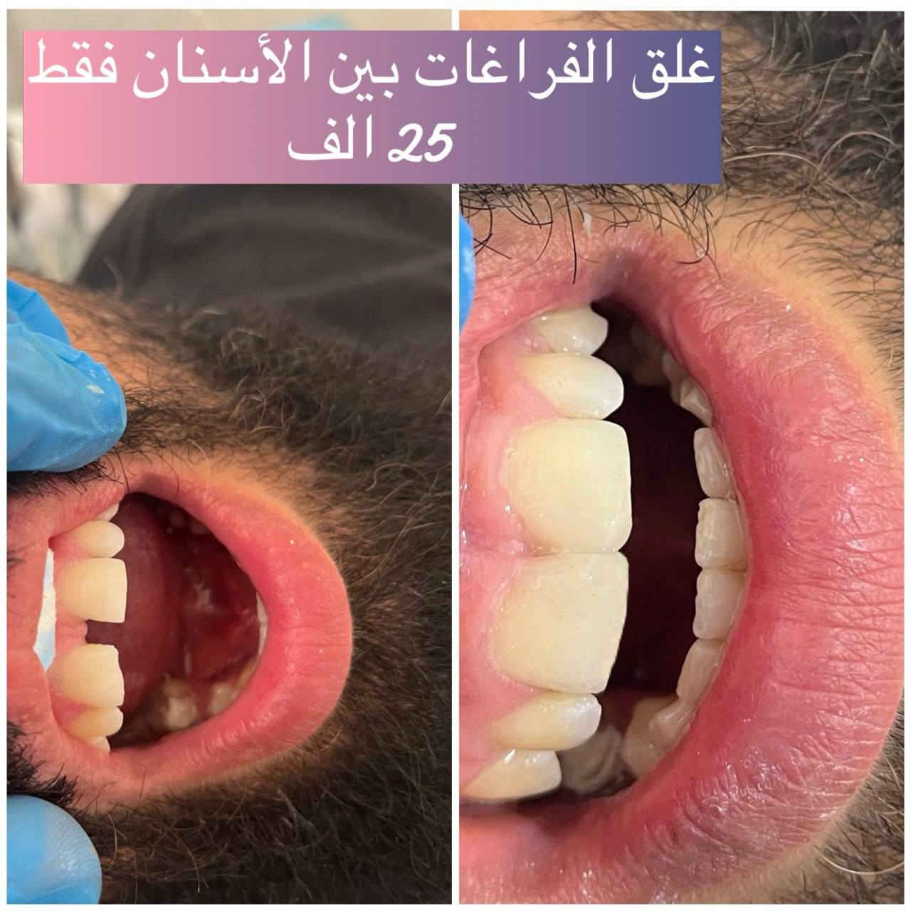 ✨ لأن ابتسامتك تفرق… إحنا نهتم بيها ✨
🦷 عيادة الدكتور د. احمد عَراك   لطب الأسنان
تعلن عن تخفيضات خاصة على جميع إجراءات الأسنان
بأيدي خبيرة، عناية دقيقة، وأسعار تناسب الكل 🤍
🔹 التغليفات:
• السيراميك: 50 ألف
• الزركون: 60 ألف
🔹 تنظيف الأسنان:
• 10 آلاف بدل 25 ألف
🔹 الحشوات التجميلية:
• 10 آلاف للسن الواحد
🎁 وعند عمل جلستين حشوات، جلسة تنظيف مجانية
لأن راحتك وصحة أسنانك تهمّنا، وفرنالك أفضل العلاجات بدون تأجيل
خلّي ابتسامتك اليوم أحلى من باچر 😁🦷
📍 العنوان: بغداد – الحسينية
مدخل التكاسي، مجاور لحوم الحسنات
📞 يرجى الحجز مسبقًا لتثبيت الموعد:
***********

