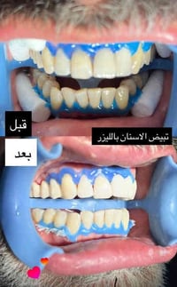 حي المهندسين • عيادة مهند السعدي • تبييض أسنان