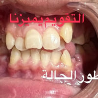 التقويم يميزنا احد اعقد و اكثر الحالات تعقيدا و صغر حجم الفكين تم قلع ...