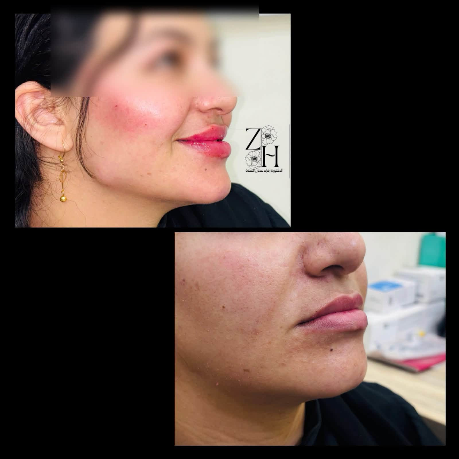 عروض عيادة الدكتورة زهراء عدنان المحنة✨💕

فلر عشرة سيسي + 
بوتكس
+ نضاره✨🤭
وتنظيف بشرة هدية✨✨✨🦋

كل هالجمال ب٣٠٠ الف فقط
وتدللون ياحلوات ✨✨

(العروبة داخل فرع مثلجات حسين وسنتر دولار)

للحجز والاستفسار التواصل على الخاص او الاتصال على الرقم التالي

📞***********
