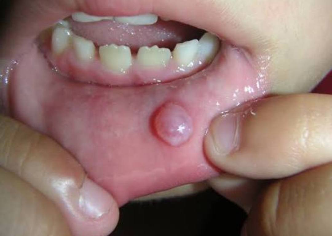 السلام عليكم
أنا طالب ماجستير في جراحة الفم  - كلية طب الأسنان 
   

يقدم فرع جراحة الفم والفكين بالكلية الخدمات الآتية 

قلع الأسنان وأضراس العقل المنطمرة  جراحيا 
زراعة الأسنان  
و متابعة أي حالة مرضية بالفم والفكين  وإزالتها جراحيا 

من لدية الحالات المذكورة   التفضل بالتواصل على الرقم 
***********     (واتساب)

تقدم الخدمات بأسعار رمزية
