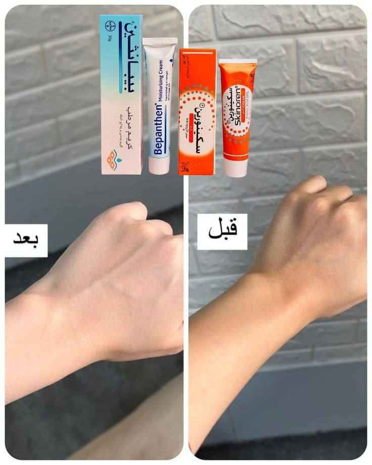 اقوى ثنائي الإزالة التصبغات الوجه والجسم والمناطق الحساسة. 
إذا تبحثين عن حل فعّال للتصبغات وعدم توحّد لون البشرة، فهذا الروتين الثنائي هو اختيارك المثالي 

1️⃣ كريم بيبانثين Bepanthen 
كريم غني بفيتامين B5، يعمل على ترطيب البشرة بعمق ويعالج الجفاف والتشققات. يساعد على تهدئة البشرة وتقليل التهيج، ويخليها ناعمة ومهيأة لاستقبال كريمات التفتيح. استخدامه المستمر يمنحك ملمس حريري ويعزز صحة البشرة بشكل عام، مما يساهم في ظهور نتائج التفتيح بشكل أفضل وأسرع.

2️⃣ كريم Skinoren سكينورين 
يحتوي على حمض الأزيليك المعروف بقدرته على تقليل التصبغات والبقع الداكنة. يساعد على توحيد لون البشرة، يخفف آثار الحبوب، وينظف المسام، بالإضافة إلى تقليل الاحمرار. مناسب للوجه والمناطق اللي تعاني من اسمرار أو تفاوت باللون، ويعطي نتائج تدريجية وآمنة مع الاستمرار.

🇩🇪 كريم بيبانثين 
المنشأ: ألمانيا
🇮🇹 كريم سكينورين 
المنشأ: إيطاليا ✨
سعر العرض ١٦ الف 
🚘يوجد خدمة توصيل لجميع محافظات العراق ٤ الاف🚘 البصرة, العراق


**إذا كنت صاحب هذا الإعلان وتريد حذفه لأي سبب، رجاءا أرسل رسالة إلى الدعم الفني**