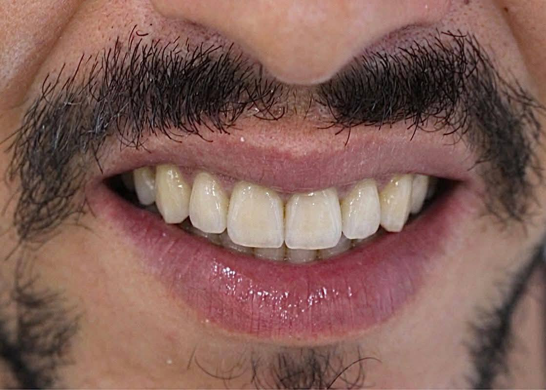 ابتسامة  ساحره وثقة مضاعفه 🩵🔥 عيادتنا فرع حي النصر 🔥🔥

تعويض الاسنان باستخدام (جسر زاركون ألماني) لمراجعنا

أبتسامتك ~ يم عيادات الفرح لطب وتجميل الأسنان ~ غير ✨😍

علماً كافة الابتسامات والحشوات مع ضمان مدى الحياة 😎

🏫
📍 العنوان :- حي النصر/ شارع السوق/ خلف جامع الأمام المهدي/فوق صيدلية مصطفى جاسم أو اسواق الزعيم 

#للحجز #والاستفسار

***********  ☎️

عيادة الفرح لطب وتجميل الأسنان

دوام العياده ⏰
فرع حي النصر 
من الساعه 4  عصرا 
إلى 
الساعه 9 مساءا
