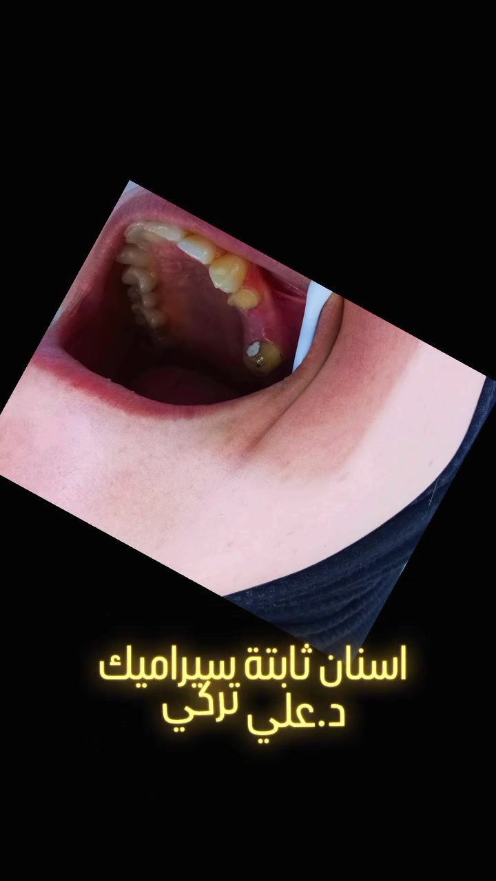 السلام عليكم  💖
تركيب اسنان ثابتة سيراميك 🎀
عي عيادتنا  💯
بغداد حي النصر نهاية شارع السوق مقابل عماد للموبايل 📌
للحجز والاستفسار  ☎️ 
د.علي تركي ⭐
0774 988 9272
