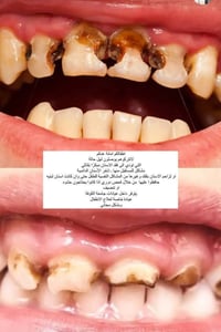 أسنان أطفال • فلورايد • المستشفى التعليمي جامعة الكوفة