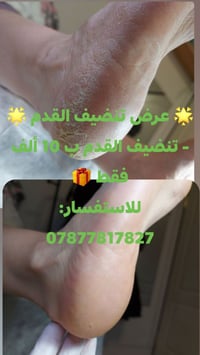 🌟 عرض تنضيف القدم 🌟 - تنضيف القدم ب 10 ألف فقط 🎁 للاستفسار: 0787781782...