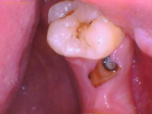 الي عندة بقايا جذور  او اسنان تالفة
يتواصل وياية حتى نخلصة منهم 
الموقع جامعة بلاد الرافدين عيادت كلية طب الاسنان 
***********
