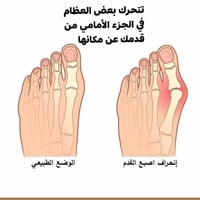 انحراف اصبع القدم الكبير 🦶نتوء عظمي يتكوَّن على المفصل عند قاعدة إصبع ...
