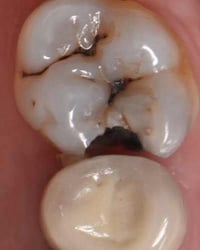 اي احد عنده مثل هذا التسوس بالفك السفلي فيتم علاج الحاله مجاناً للحجز ...