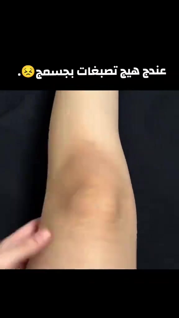 عصارة موفيت                 MOVATE  CREAM
لتفتيح وتصفية البشرة 
فوائدها :-👇👇
١- تساعد على تقشير وتفتيح البشرة 
٢-تساعد على تفتيح الندباتl
٣- ازالة البقع السمراء والتصبغات بالبشرة
٤- علاج الكلف والنمش 
٥- معالجة اي بقع داكنة بالوجه او الجسم 
٦-علاج اثار حب الشباب

طريقة الاستعمال :-👇👇
تغسل المنطقة جيدا ليلا  بغسول او صابون ثم تنشف وبعدها يوضع الكريم طبقة خفيفة مع التدليك الى ان تمتصه البشرة
ثم تترك للصباح وبعدها يتم الغسل بغسول او صابون نوعية جيدة 💓💓

السعر ٦ الاف فقط


**إذا كنت صاحب هذا الإعلان وتريد حذفه لأي سبب، رجاءا أرسل رسالة إلى الدعم الفني**