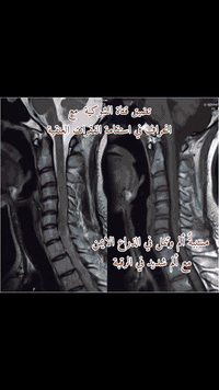 #الدكتور مكرم نورالدين 🥼🩺
#مجمع الكندي الطبي 
 #اخصائي_جراحة_الدماغ_الجمله_العصبيه_والفقرات
( جراحة الجملة العصبية ) 
☎️☎️☎️***********☎️☎️☎️
 
♦️عمليات نزف الدماغ واورام الدماغ بالجراحة المجهرية والناظورية
♦️ عمليات اورام الحبل الشوكي والانزلاق الغضروفي بالجراحة المجهرية
♦️عمليات تثبيت الفقرات بالبراغي
♦️علاج آلام الرقبة وآلام الظهر والانزلاق الغضروفي وعرق النسا
♦️علاج الصداع ( الشقيقة - الصداع العنقودي )
♦️علاج الصرع 

عيادة دكتور مكرم نورالدين مسرهد جراحة الدماغ والفقرات
