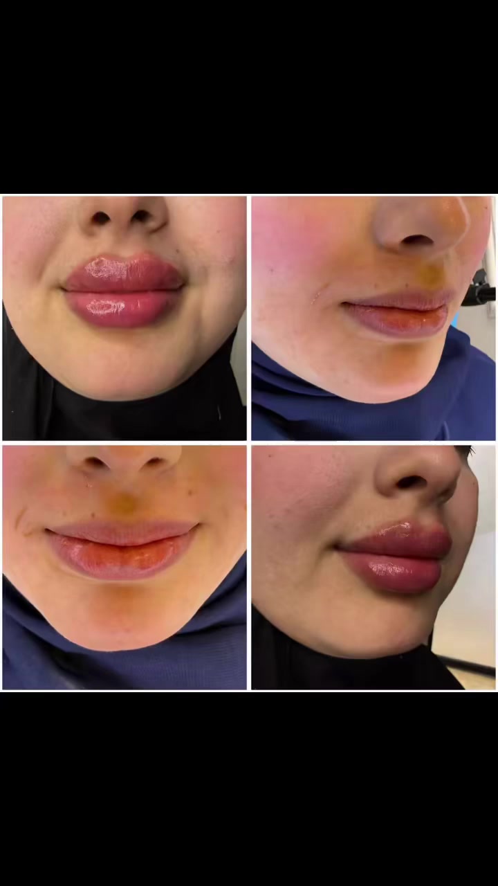 💋✨ مع المطر… لمسة فيلر تعطيك دفا وأناقة 
 #فيلر


**إذا كنت صاحب هذا الإعلان وتريد حذفه لأي سبب، رجاءا أرسل رسالة إلى الدعم الفني**