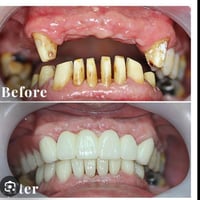 مجانا و لفترة محدودة ‼️ عمل تركيبات أسنان ثابتة (تيجان و جسور) في عياد...