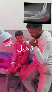 #كسر_المرفق من أصعب الكسور التي قد تواجهها، ليس بسبب الألم فقط، بل لأن...