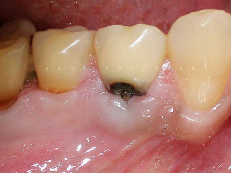 الي عندة مثل هاي الحالات ومحتاج حشوات أو قلع للاسنان والجذور المتبقية العلاج مجاني داخل عيادات جامعة واسط وبأشراف اطباء مختصين 
تواصلوا وياي  عالواتساب او التليجرام 

0770 302 8114
