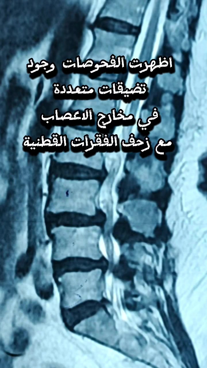 عملية كانت تتطلب السفر لمسافات بعيدة صارت تجرى اليوم داخل مستشفى حديثة العام. 
تم اجراء عملية تثبيت الفقرات القطنية لمريضة تعاني من زحف الفقرات مع تضيقات متعددة في مخارج الاعصاب للفقرات القطنية. 
المريضة كانت تعاني من الم اسفل الظهر مع خدر الاطراف السفلى وعدم القدرة على المشي لامتار قليلة... 
الدكتور هيثم احمد الطائي
اخصائي جراحة الدماغ والعمود الفقري
بورد عربي (دكتوراه) جراحة الجملة العصبية
حديثة - مجمع عمر الطبي - شارع الطوارئ المستشفى الجديد
رقم الحجز : ***********
