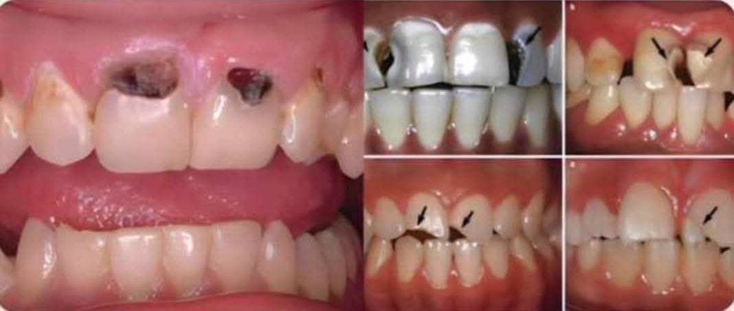 تعاني من ألم سن أو تحتاج تنظيف أو حشوة؟ 🦷
✔️ قلع الأسنان بدون ألم
✔️ تنظيف وإزالة التكلسات 
✔️ حشوات تجميلية وعلاج التسوس
✨ العمل مجاني وتحت إشراف أطباء اختصاص ✨
👩‍⚕️ د. زهراء عدنان
📞 للحجز: ***********

📍الحر _ عيادات جامعة أهل البيت عليهم السلام
