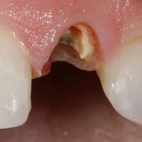 قلع أسنان مجاني • سن مكسور • بغداد كلية السلام