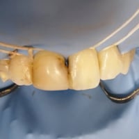 ترميم أسنان أمامية • عيادة أسنان • القيارة