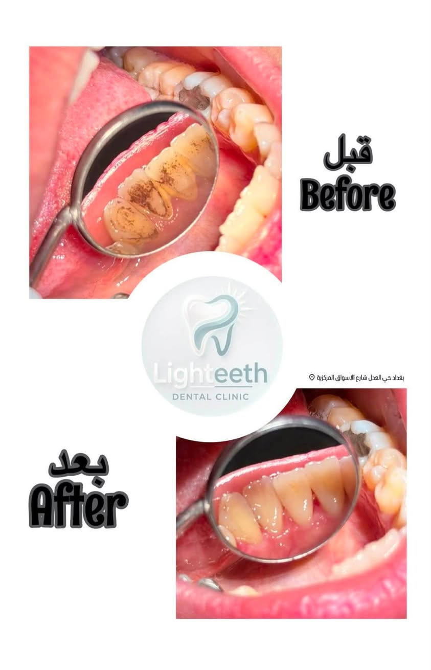 عيادةlighteeth
لدكتور
اسامة احمد الحسني
لزراعة وتقويم وتجميل الاسنان توجد خدمة طوارئ الاسنان
وتتواجد طبيبة 
تجميل أخصائية
فلروبوتوكس ونضارة للوجهه
أوقات الدوام
من الساعة ال ١٠ صباحاٍ حتى الساعة ال ١٠ مساءا
موقع العيادة:
حي العدل
-شارع الأسواق المركزية -
مجاور حاجة الف
لحجز واتساب او التواصل عبر الخاص.
***********
