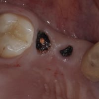 � متوفر قلع مجاني لبقايا جذور الأسنان التالفة 📅 متوفر حجز يوم غداً الا...